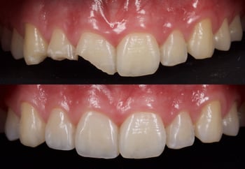 SW123-Composite-Direct Anterior Resin-Thumbnail