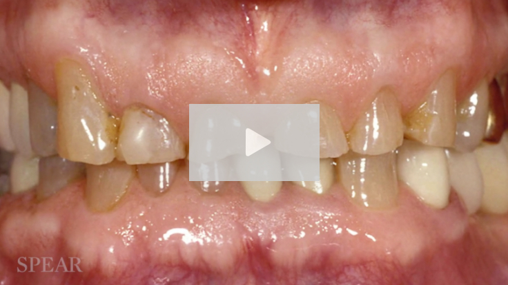 Treating the Worn Dentition Treating the Worn Dentition