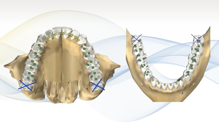 Free-Content-Occlusal-LP