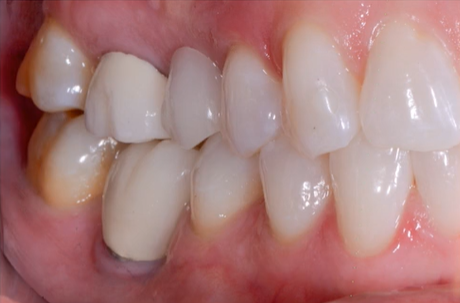 Implant treatment planning, opens in new window