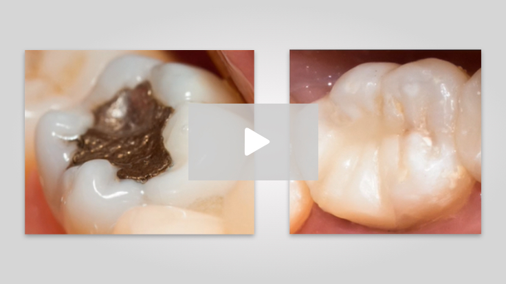 Amalgam vs. Composite: Factors Affecting Longevity