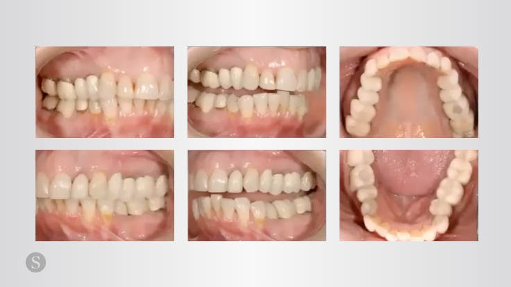 Clinical Tips to Increase the Insertion Predictability of Indirect Restorations