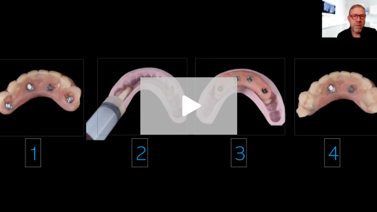 Implant Surgery: Guided, Non-guided or Mis-guided