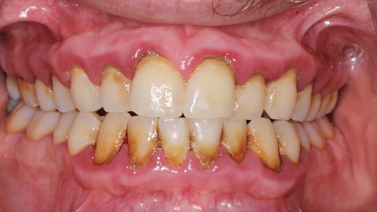 LP-Grading-Periodontics