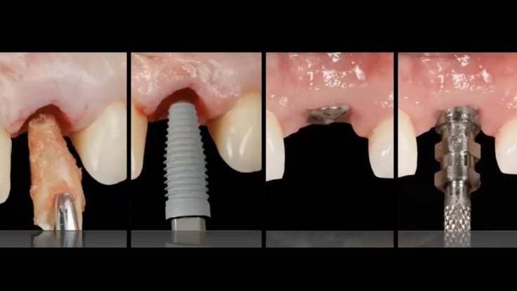 Implants - The Surgical/Restorative Connection  Implants - The Surgical/Restorative Connection