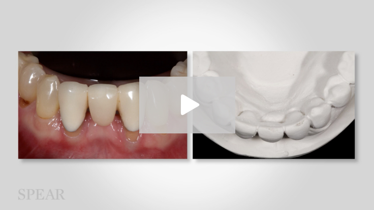 Managing the Compromised Case - Implants, Occlusion, and Lack of Keratinized Tissue