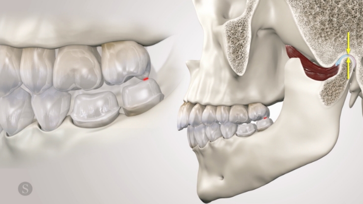 Characteristics of an Angle’s Class II Occlusal Relationship