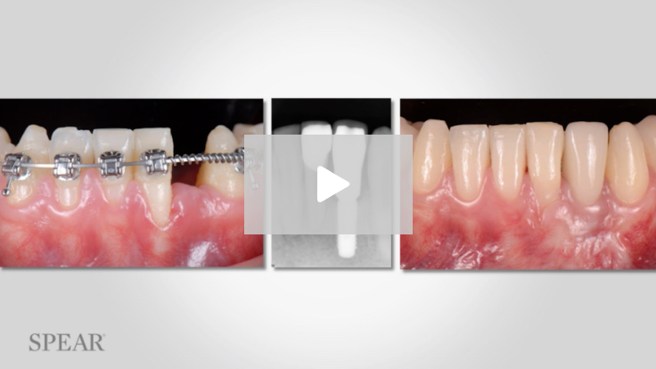 Overcoming Space Limitation for Implants in the Anterior Mandible Overcoming Space Limitation for Implants in the Anterior Mandible