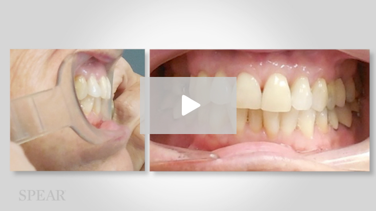 The TMD Connection to Upper Airway Resistance Syndrome’
