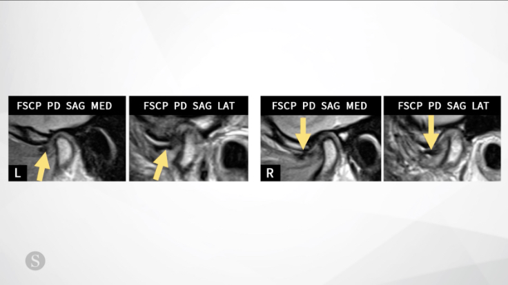 TMJ MRI Basics