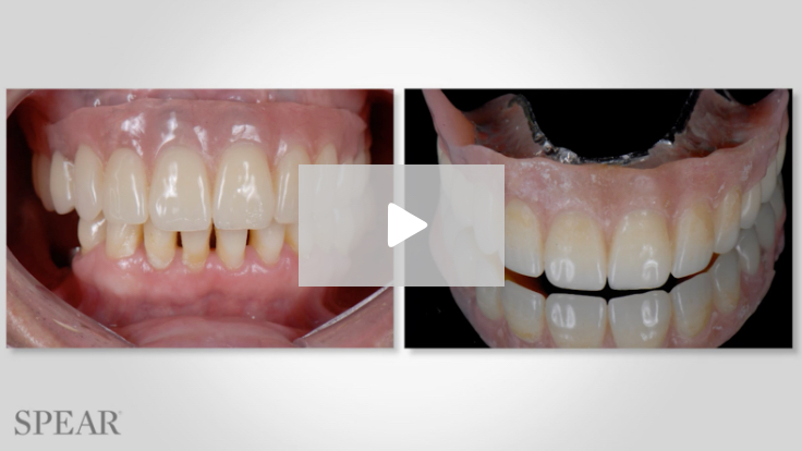 Caroline –Upgrading  an Implant-Supported  Overdenture  to a Fixed  Design Caroline –Upgrading  an Implant-Supported  Overdenture  to a Fixed  Design