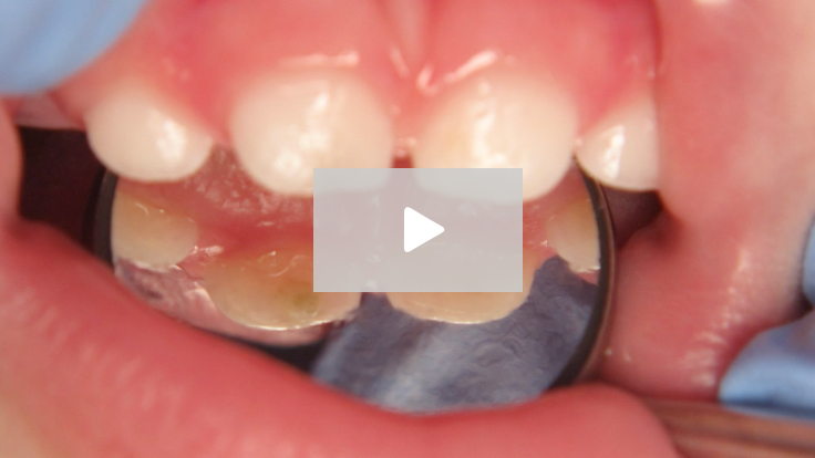 Introduction to the Medical Management of Dental Caries