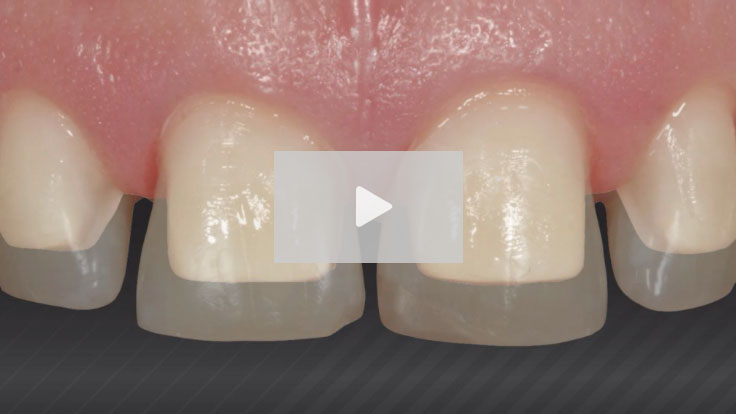 Acquisition-Interproximal-LP-image