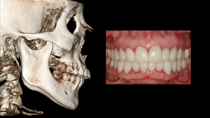 Defining Occlusal Stability