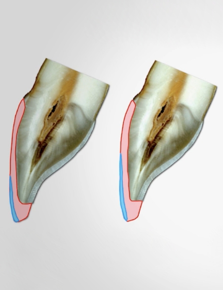 Indirect Restoration Fundamentals, opens in new window